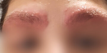 Место тетовирани веѓи и направиле живи рани: Скопјанка објави фотографии од третманот