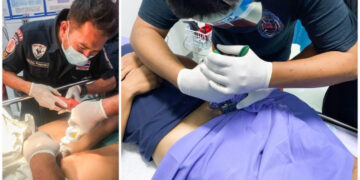 Платил 15.000 евра за да му го зголемат пенисот, а девојката му рекла: Голем ти е како нож за бифтек