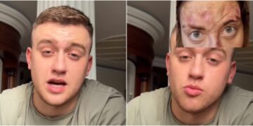 Раните на лицето на Ана Николиќ не се од дрога и алкохол, туку од лоши ласерски третмани, тврди тиктокер од Србија