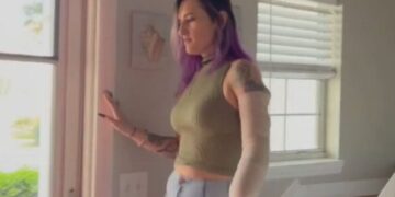 Девојка остана без половина рака поради фен: еве како ѝ се случи оваа страшна несреќа